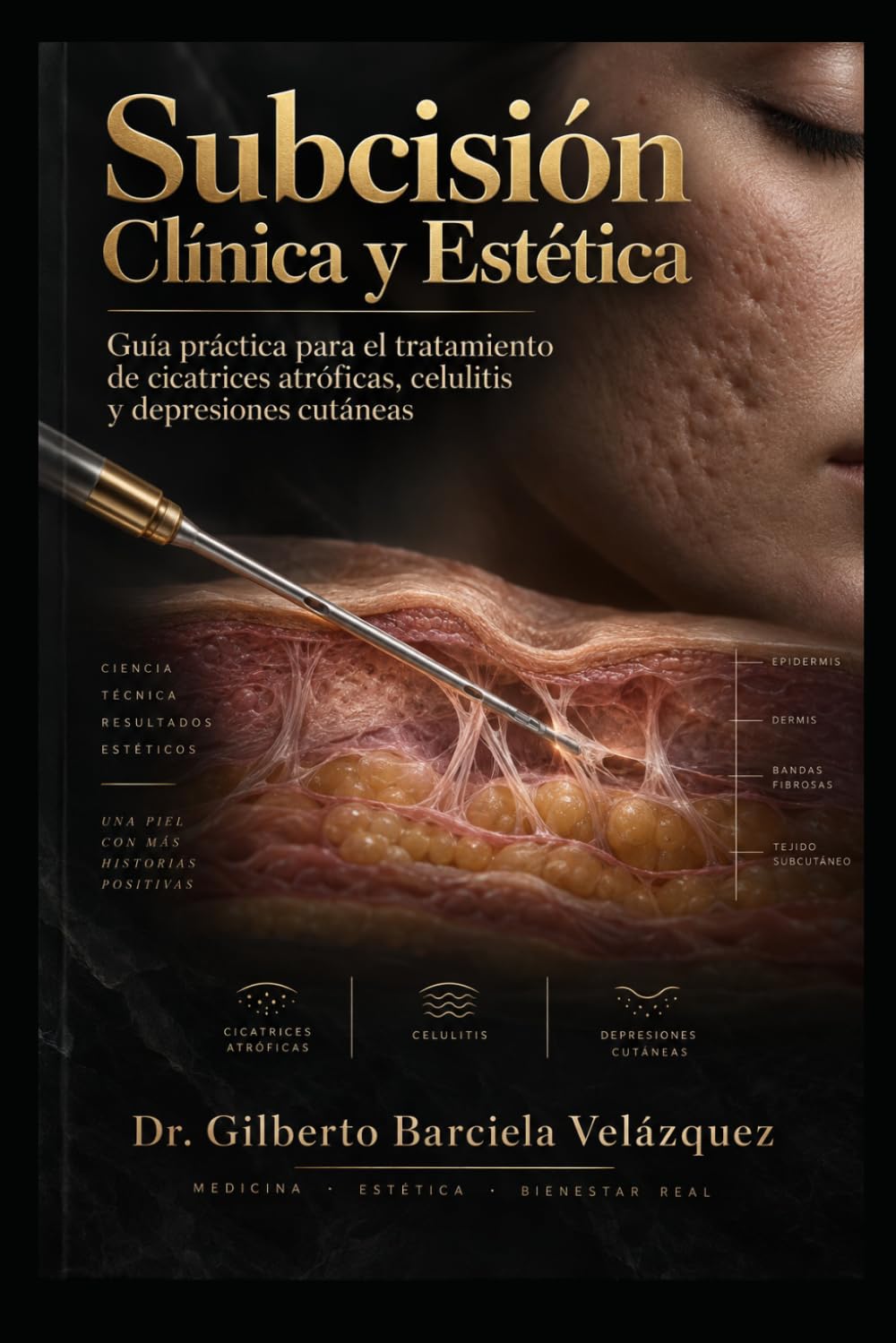 Subcisión Clínica y Estética: Guía Completa para el Tratamiento de Cicatrices Atróficas, Celulitis y Depresiones Cutáneas (Spanish Edition)