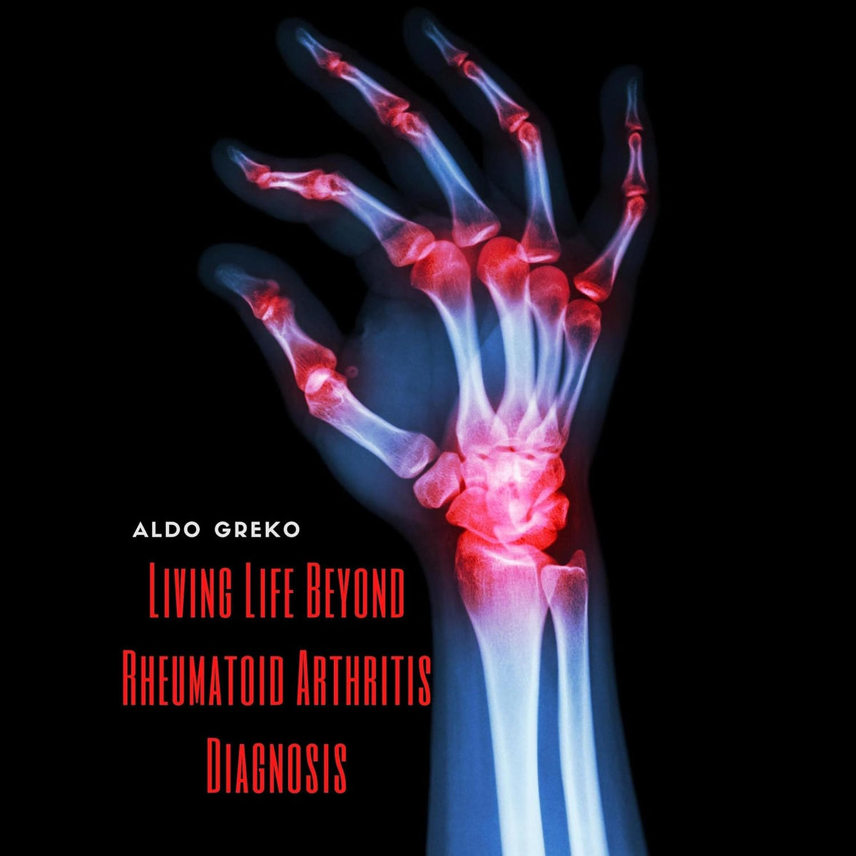 Living Life Beyond Rheumatoid Arthritis Diagnosis: Proper Diets and Meal Plans in Conjunction with Medication, Exercise, and Supplements Will Help Manage Rheumatoid Arthritis